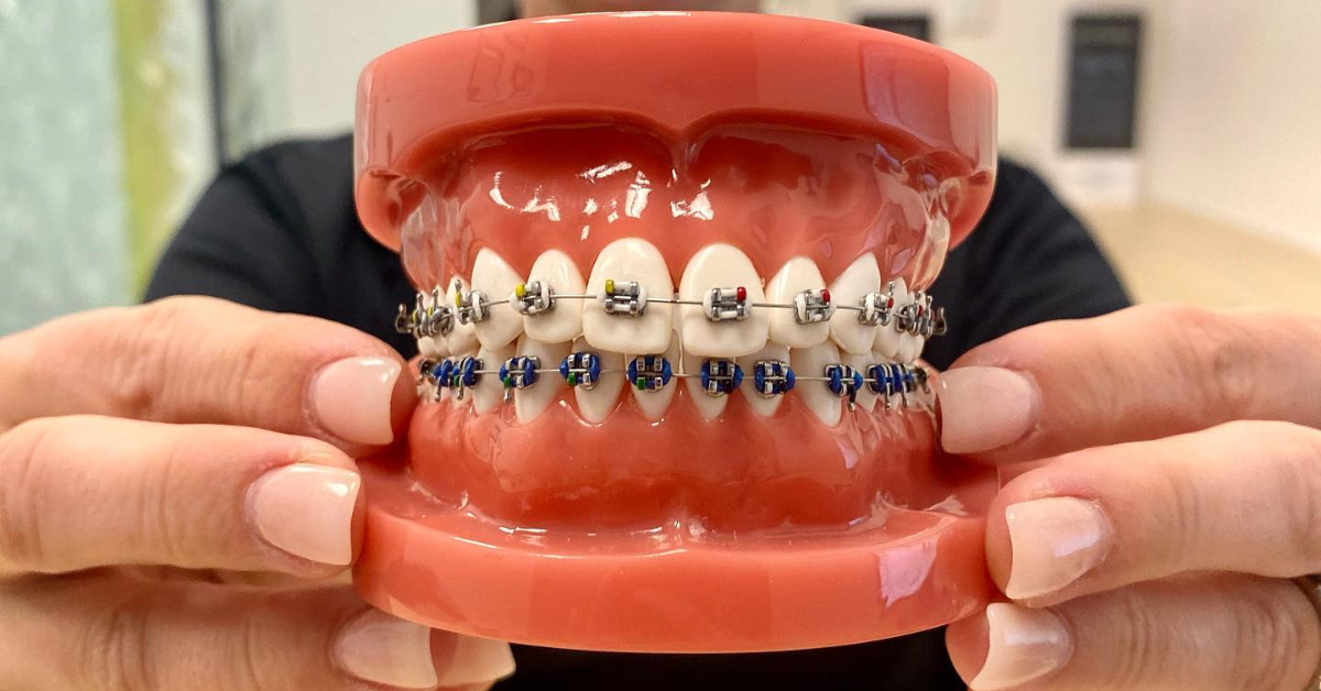 The Top 10 Myths About Orthodontic Treatment Debunked
